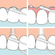 TePe Bridge & Implant Floss nić dentystyczna do mostów i implantów 30szt
