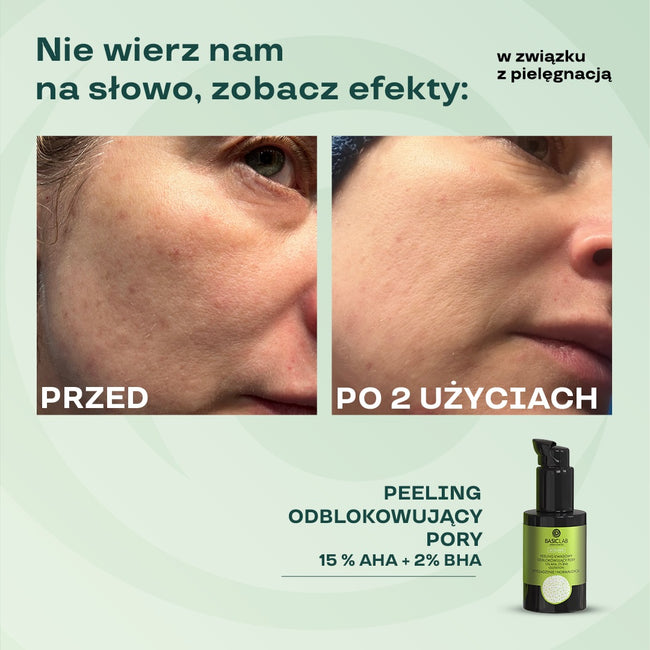 BasicLab Acidumis peeling kwasowy odblokowujący pory z 15% AHA i 2% BHA 30ml