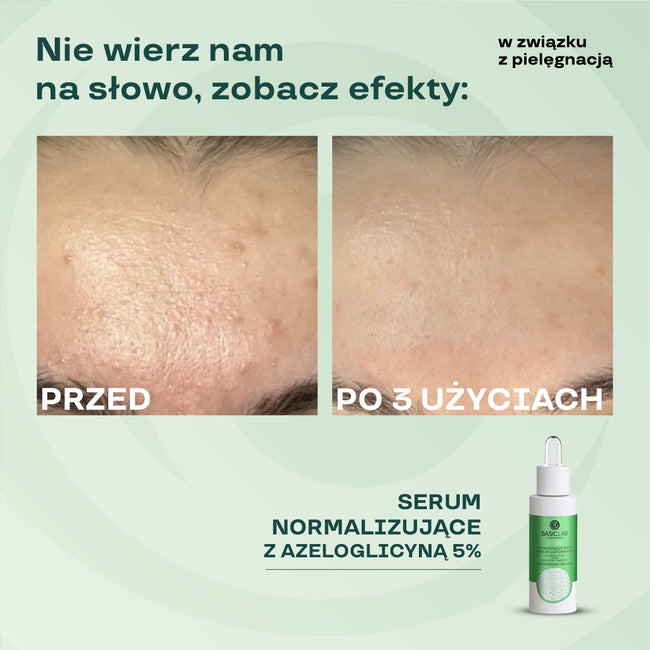 BasicLab Esteticus normalizujące serum przeciw zaskórnikom z 5% azeloglicyny i 1% BHA 30ml