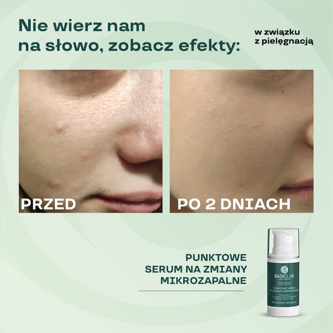 BasicLab Esteticus punktowe serum na zmiany mikrozapalne z 7% AHA/BHA i 3% kwasu azelainowego Wyciszenie i Redukcja 15ml